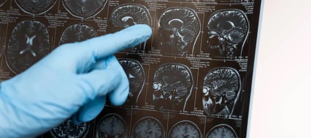 La AI contra el Alzheimer